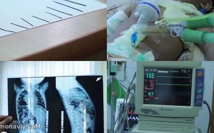 Бош прокуратура: Танасидан 16 та игна топилган гўдак иши бўйича жиноят иши қўзғатилди