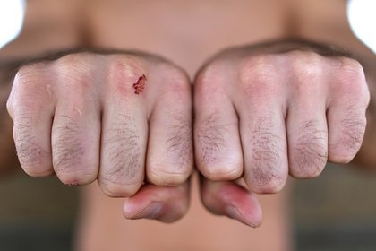 Итальянского бойца ввели в кому после кулачного поединка без перчаток