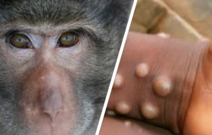 ВОЗ сообщила о 646 случаях оспы обезьян в мире в мае